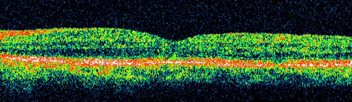 coherence optique oct